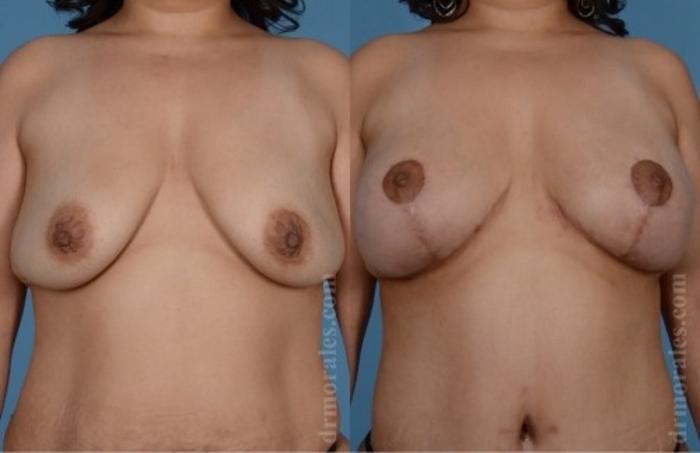 Before & After Breast Augmentation With Lift Case 668 View 1 View in Houston, TX