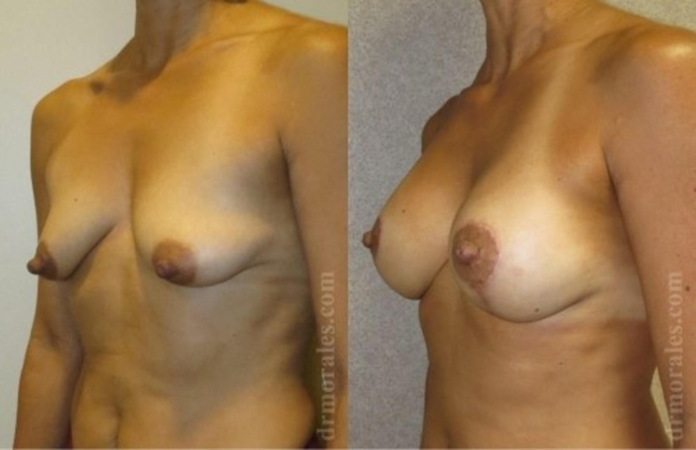 Before & After Breast Augmentation With Lift Case 670 View 1 View in Houston, TX