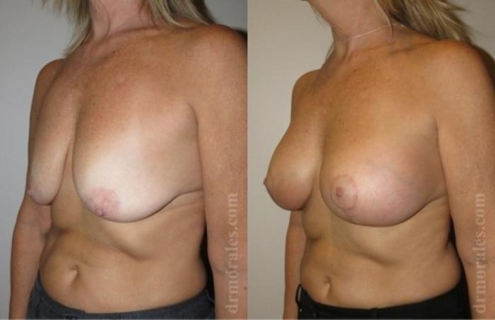 Before & After Breast Augmentation With Lift Case 671 View 1 View in Houston, TX