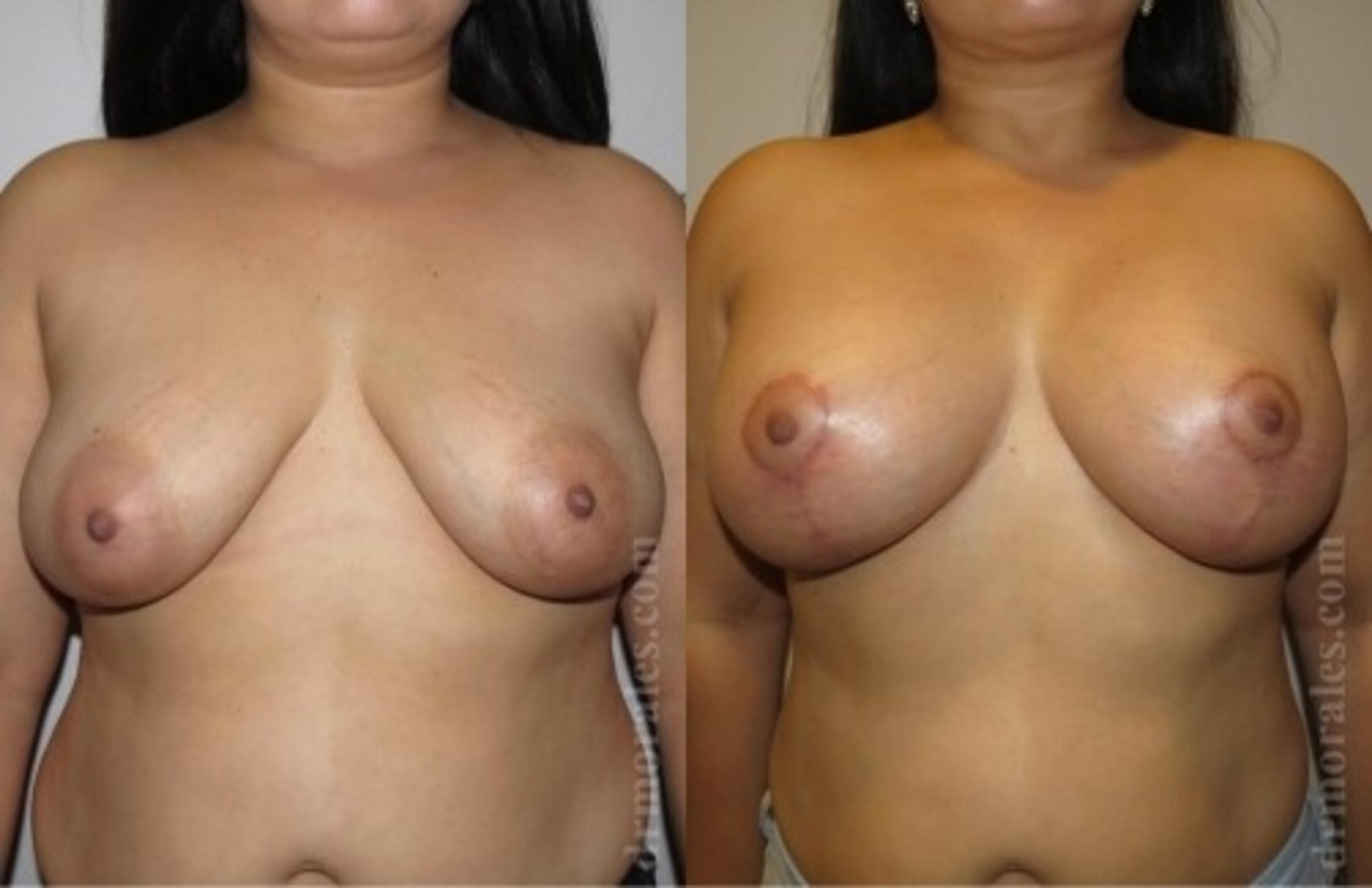 Before & After Breast Augmentation With Lift Case 672 View 1 View in Houston, TX