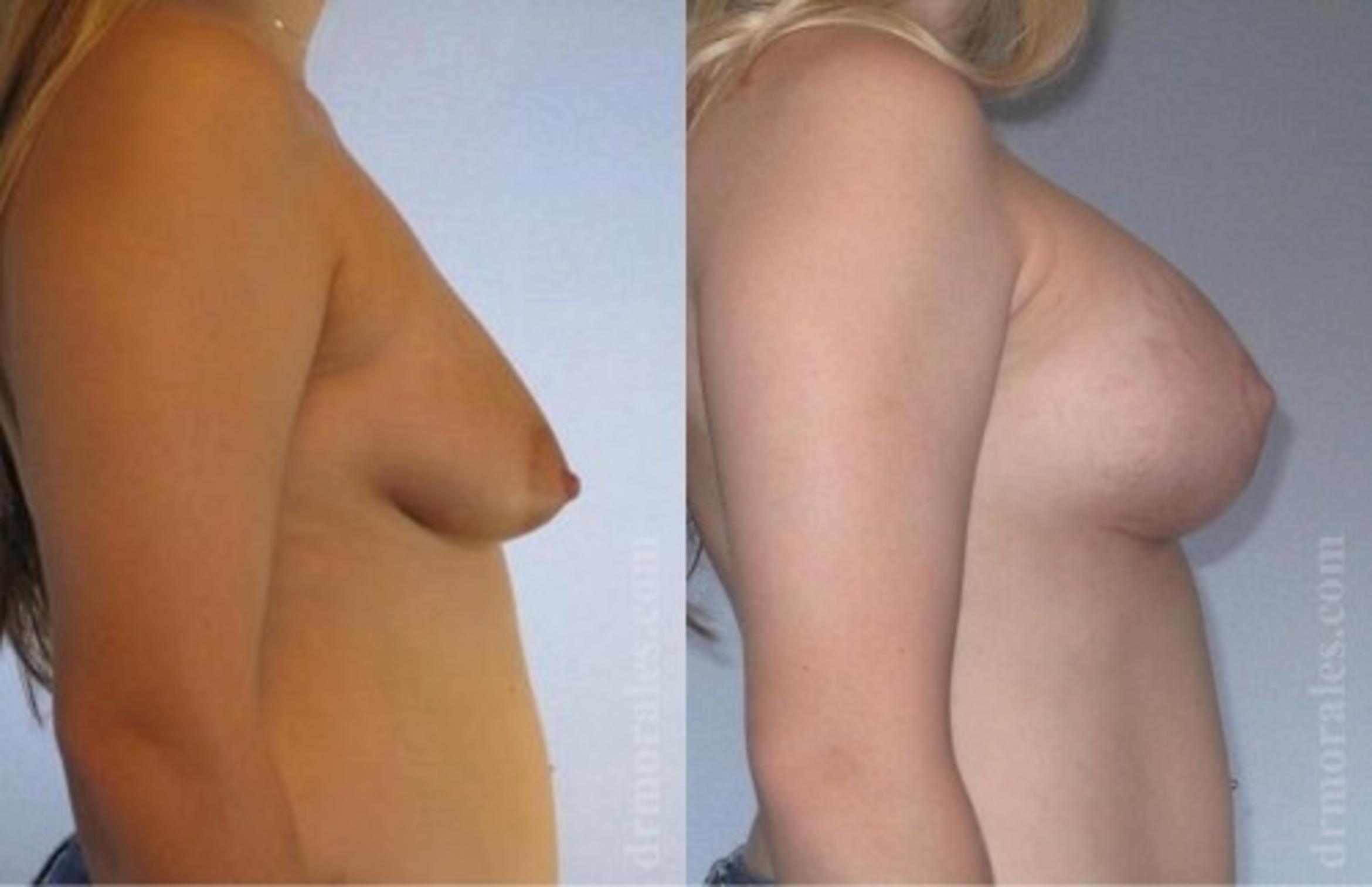 Before & After Breast Augmentation With Lift Case 673 View 1 View in Houston, TX
