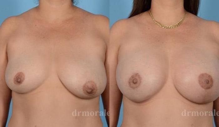 Before & After Breast Augmentation With Lift Case 674 View 1 View in Houston, TX