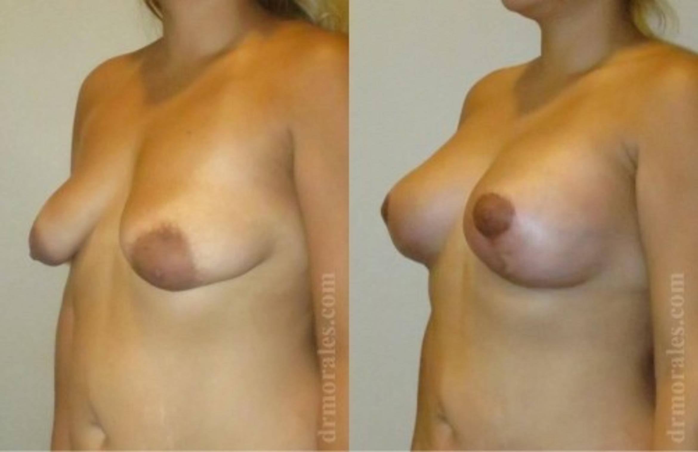 Before & After Breast Augmentation With Lift Case 675 View 1 View in Houston, TX