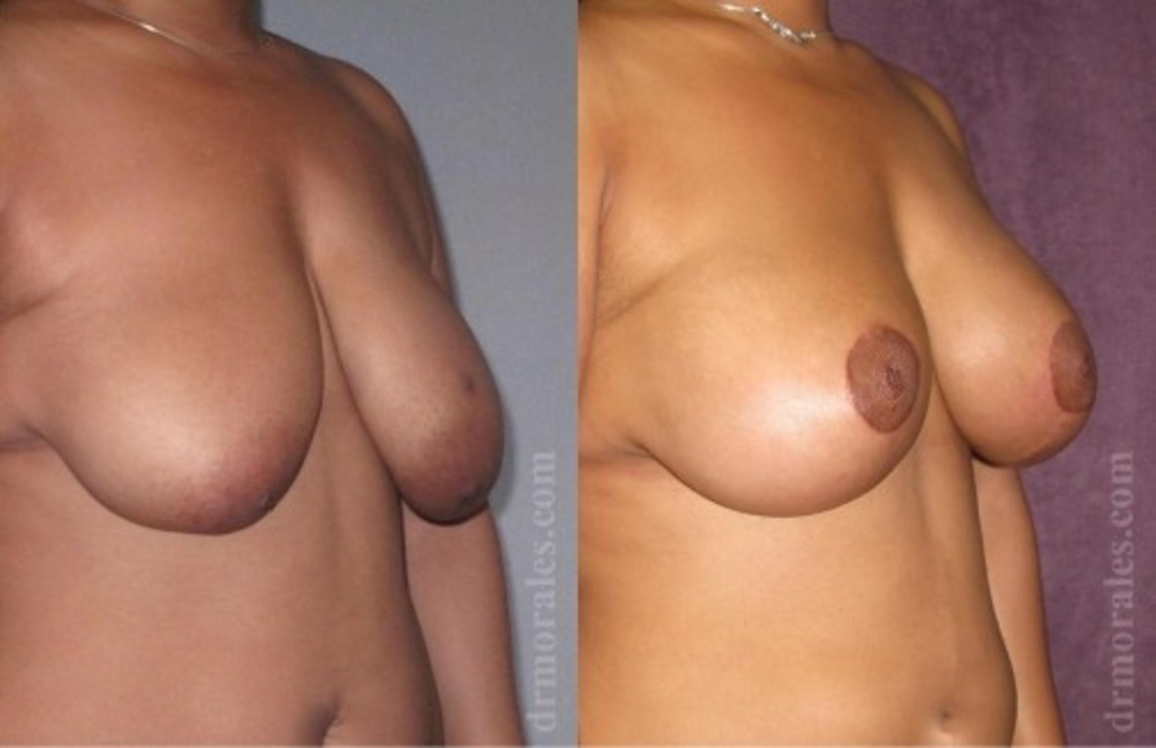Before & After Breast Augmentation With Lift Case 676 View 1 View in Houston, TX