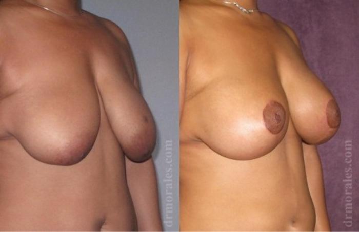 Before & After Breast Augmentation With Lift Case 676 View 1 View in Houston, TX