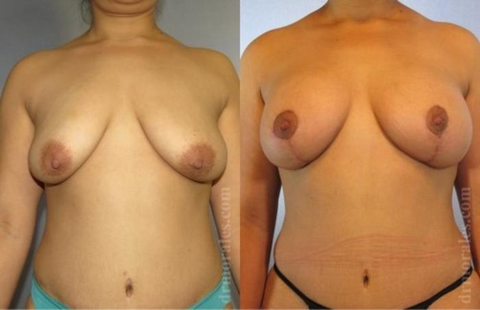 Before & After Breast Augmentation With Lift Case 677 View 1 View in Houston, TX
