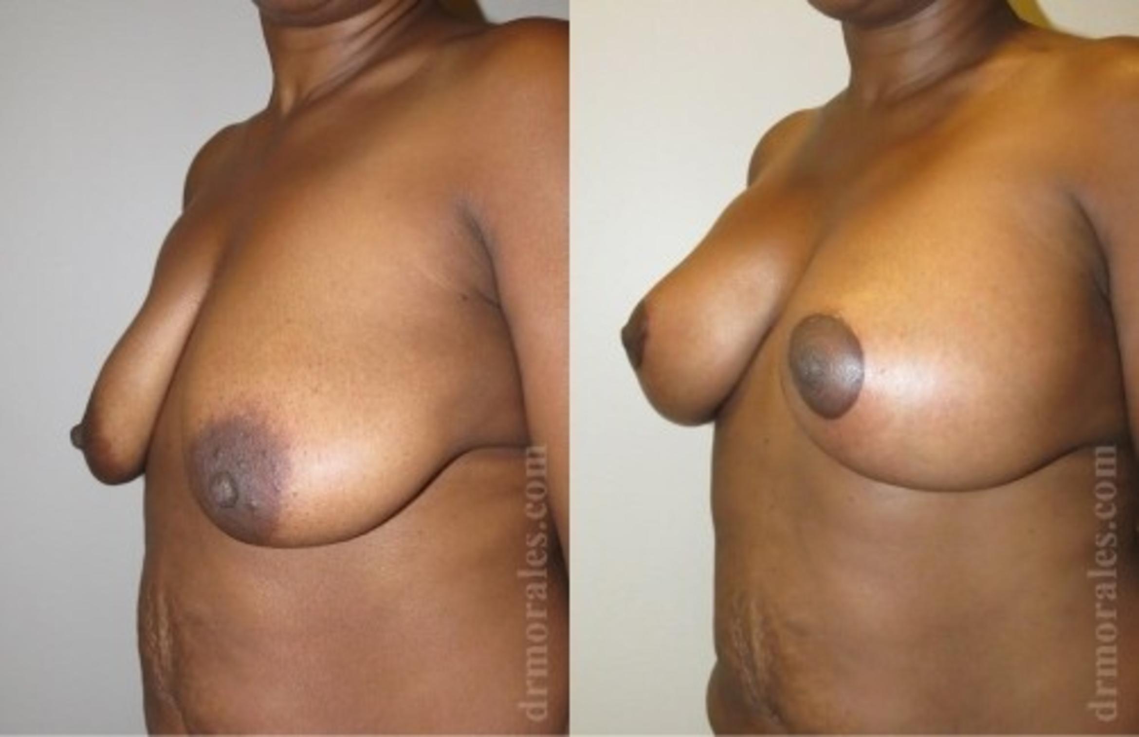 Before & After Breast Augmentation With Lift Case 678 View 1 View in Houston, TX