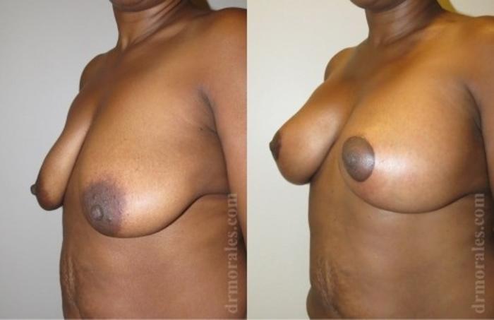Before & After Breast Augmentation With Lift Case 678 View 1 View in Houston, TX