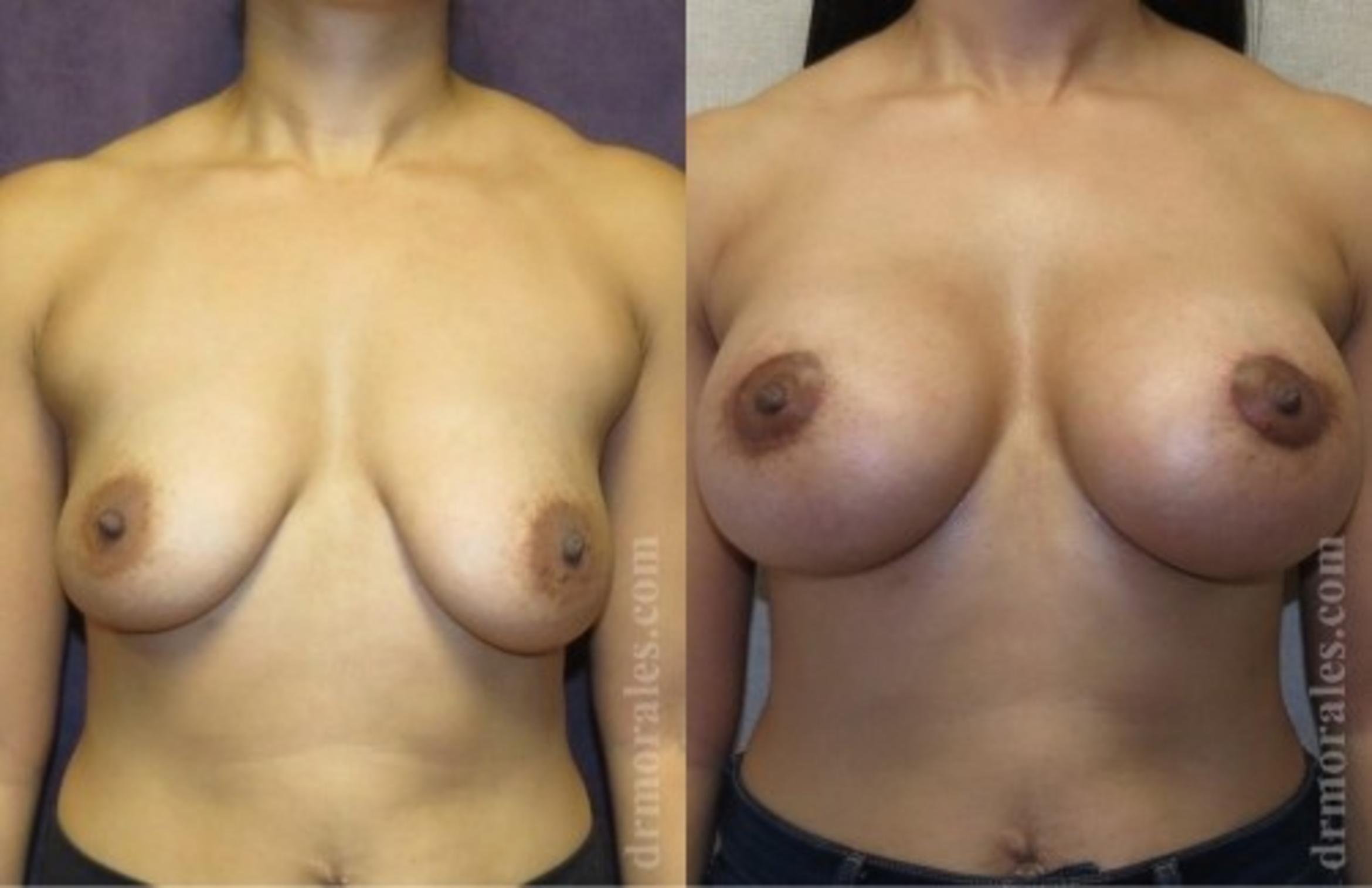 Before & After Breast Augmentation With Lift Case 679 View 1 View in Houston, TX