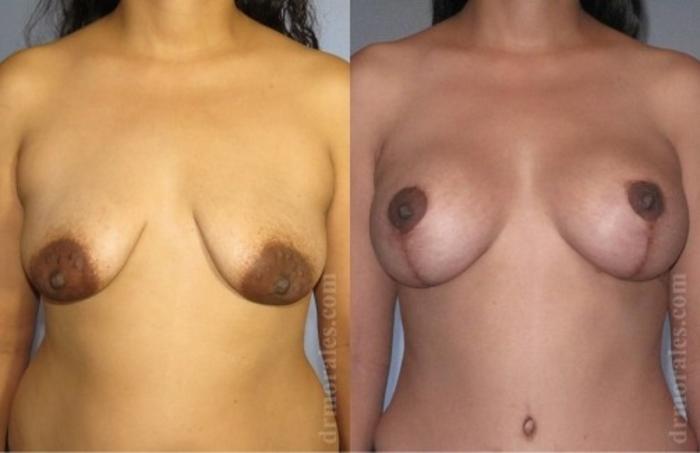 Before & After Breast Augmentation With Lift Case 680 View 1 View in Houston, TX