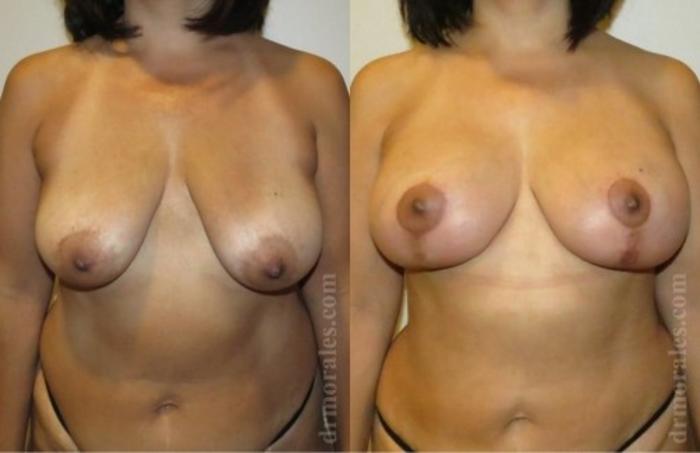 Before & After Breast Augmentation With Lift Case 681 View 1 View in Houston, TX