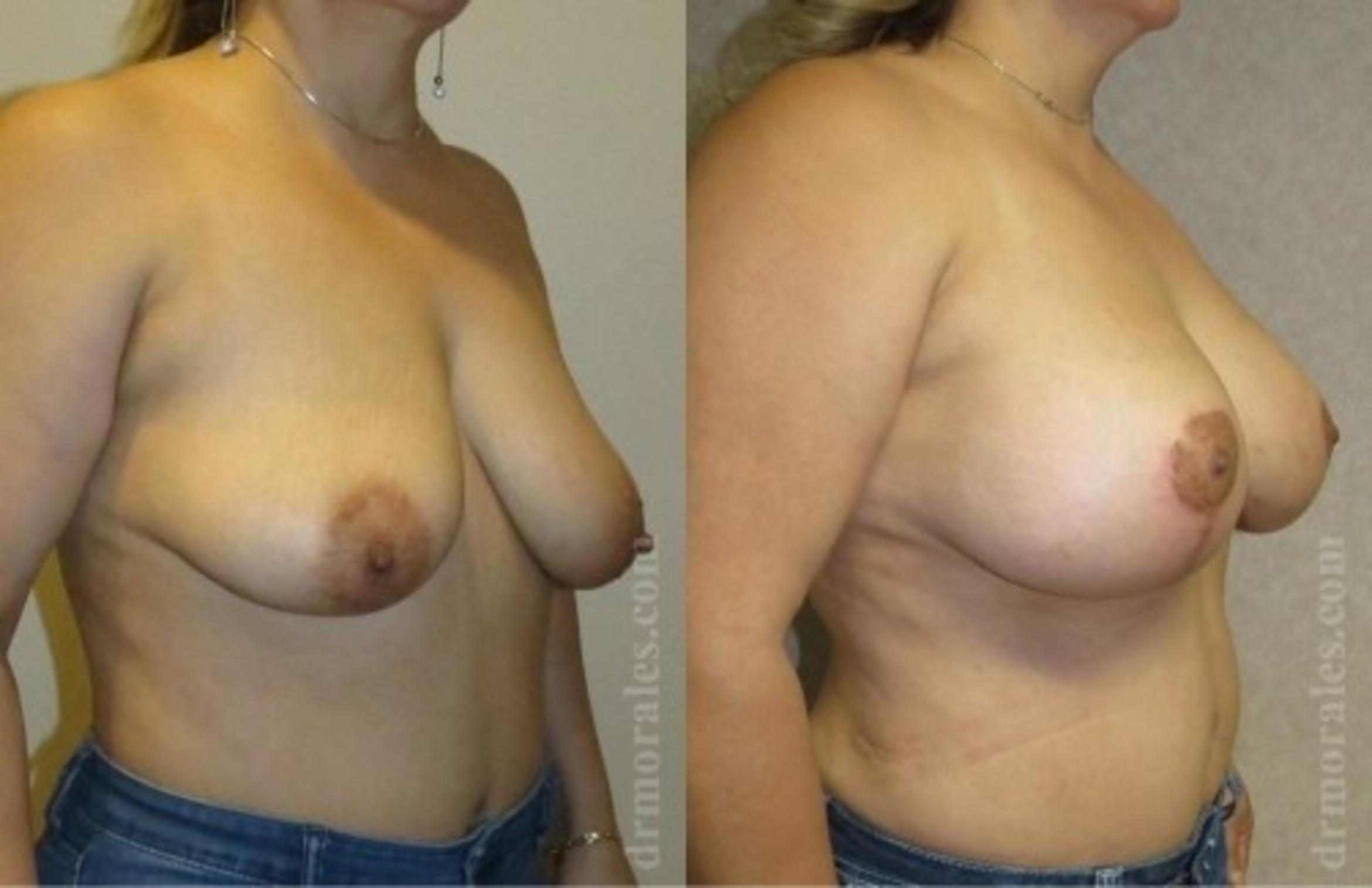 Before & After Breast Augmentation With Lift Case 682 View 1 View in Houston, TX