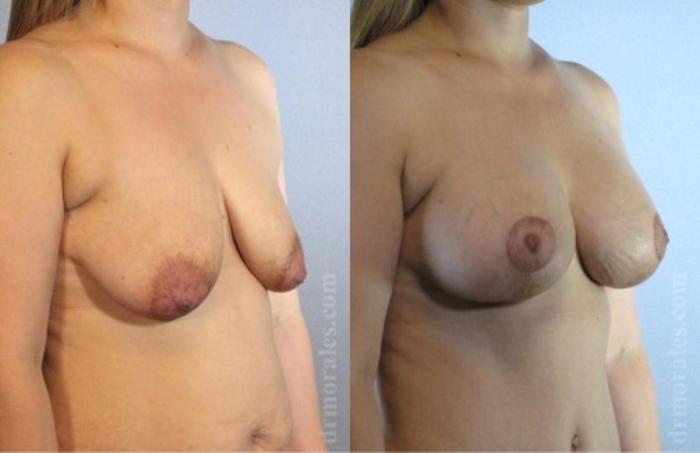 Before & After Breast Augmentation With Lift Case 684 View 1 View in Houston, TX