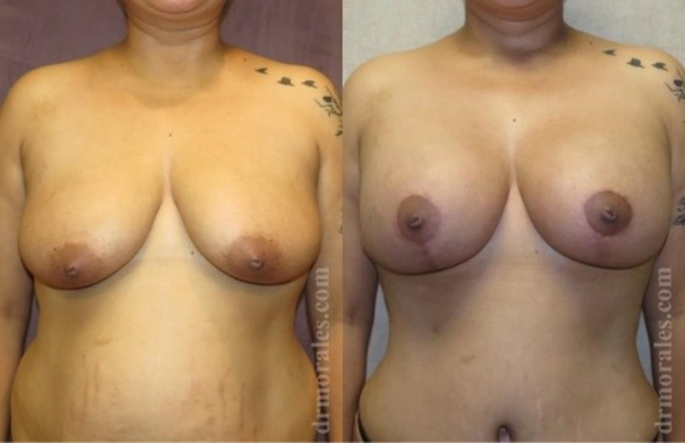 Before & After Breast Augmentation With Lift Case 685 View 1 View in Houston, TX