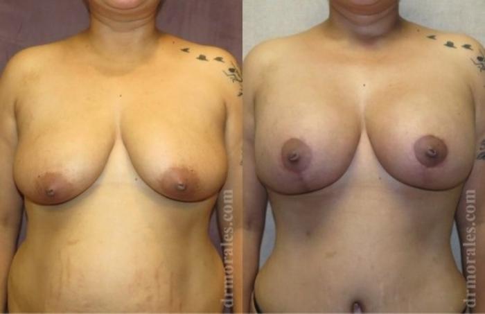 Before & After Breast Augmentation With Lift Case 685 View 1 View in Houston, TX