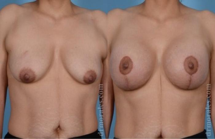 Before & After Breast Augmentation With Lift Case 687 View 1 View in Houston, TX