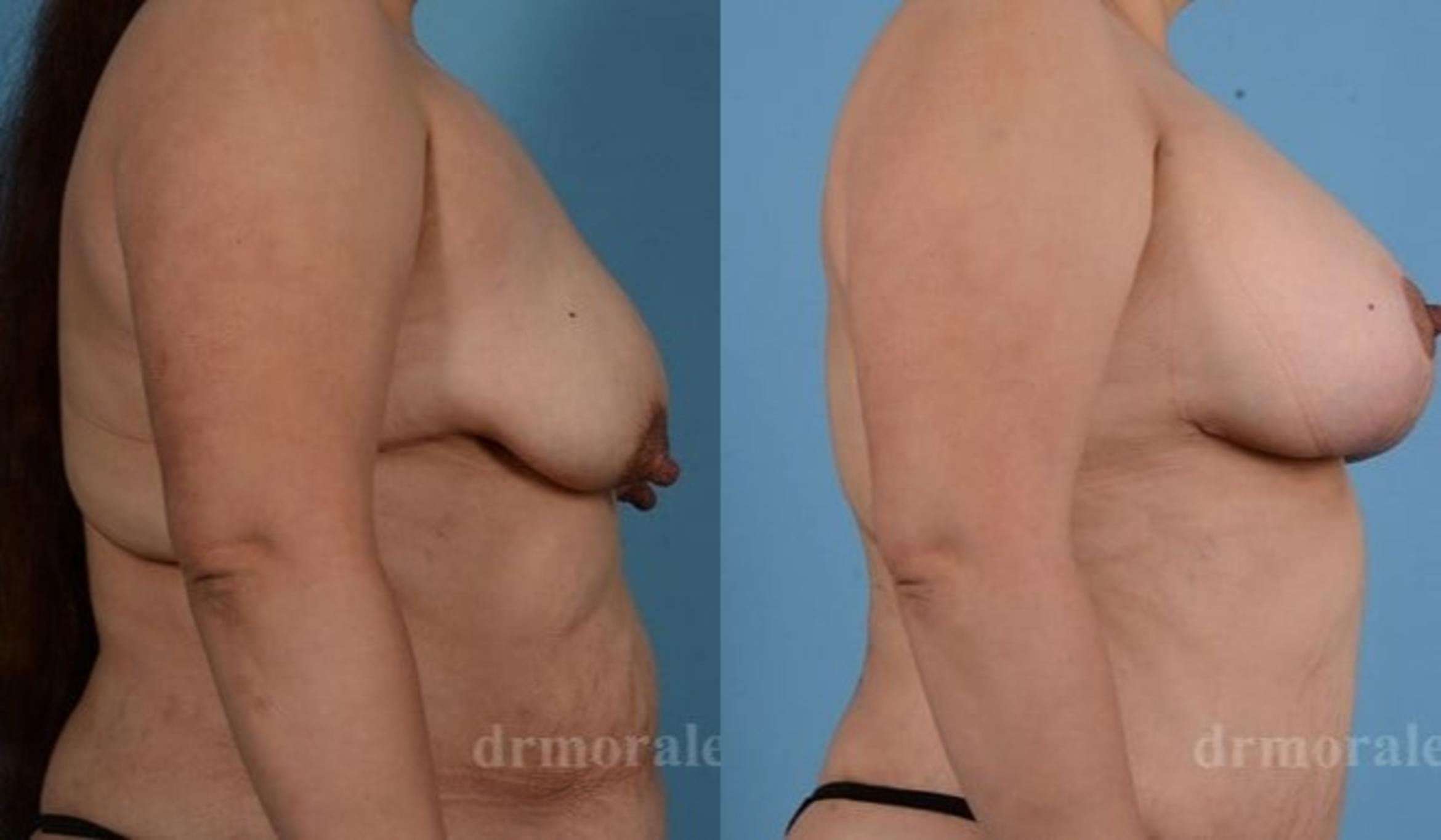 Before & After Breast Augmentation With Lift Case 688 View 1 View in Houston, TX