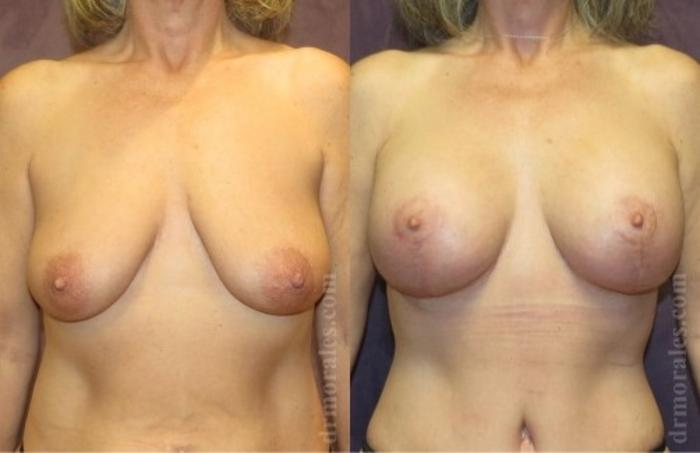 Before & After Breast Augmentation With Lift Case 689 View 1 View in Houston, TX