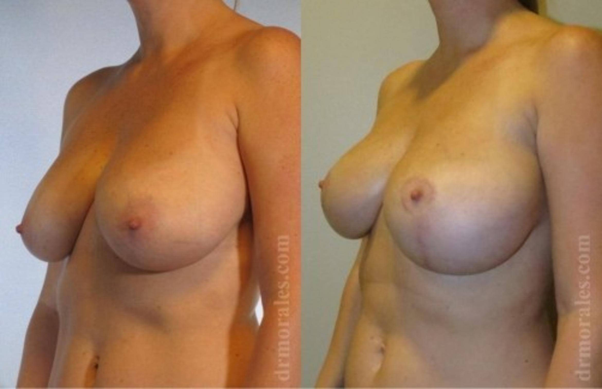 Before & After Breast Augmentation With Lift Case 690 View 1 View in Houston, TX