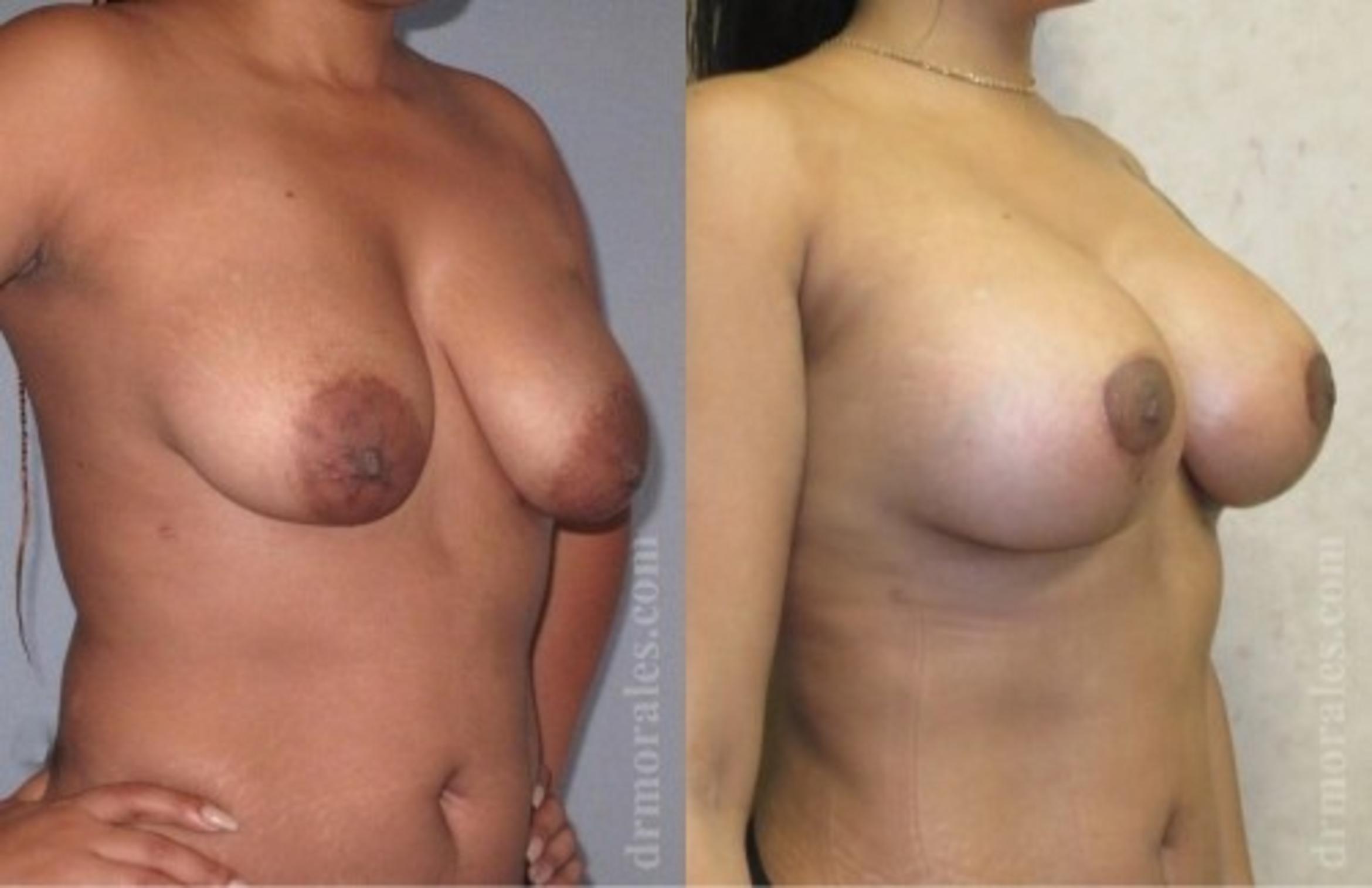 Before & After Breast Augmentation With Lift Case 691 View 1 View in Houston, TX