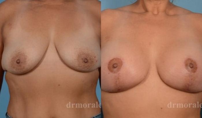 Before & After Breast Augmentation With Lift Case 692 View 1 View in Houston, TX
