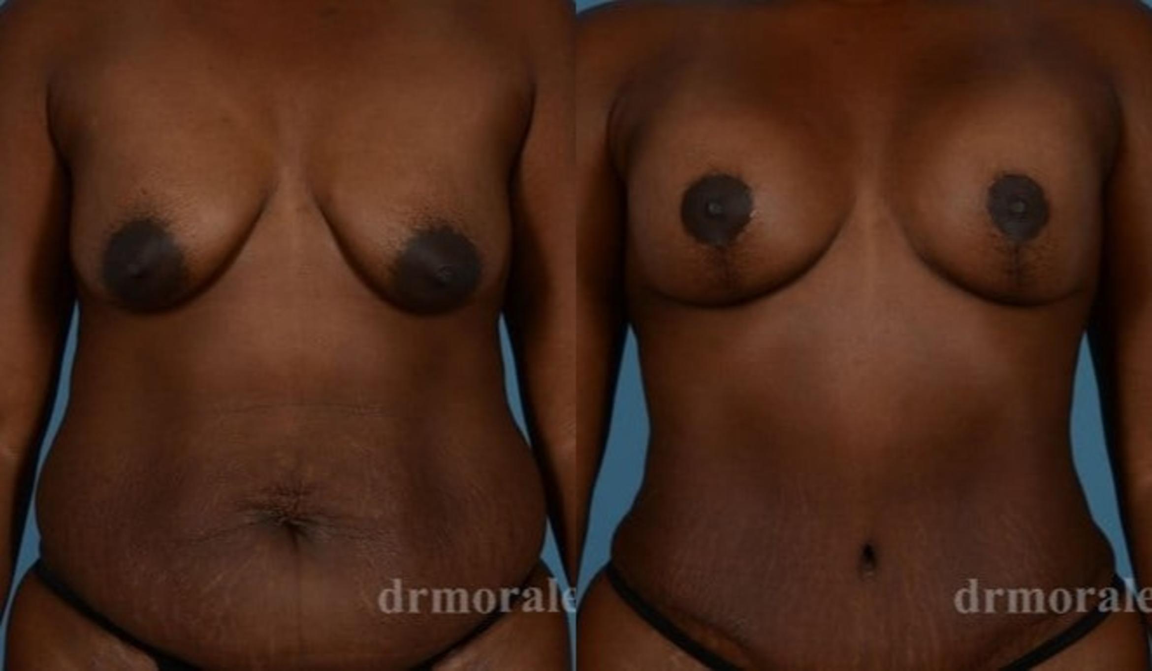 Before & After Breast Augmentation With Lift Case 693 View 1 View in Houston, TX