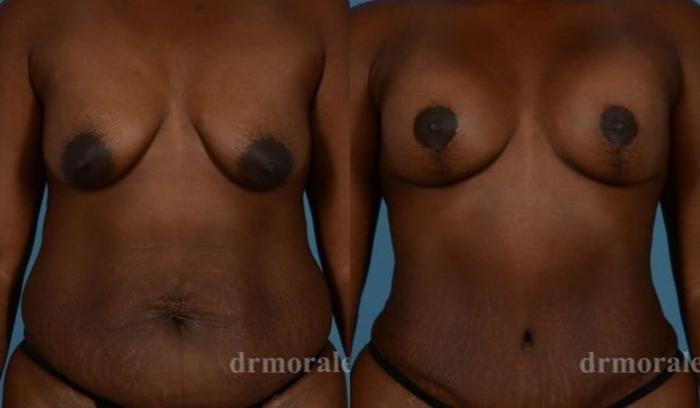 Before & After Breast Augmentation With Lift Case 693 View 1 View in Houston, TX