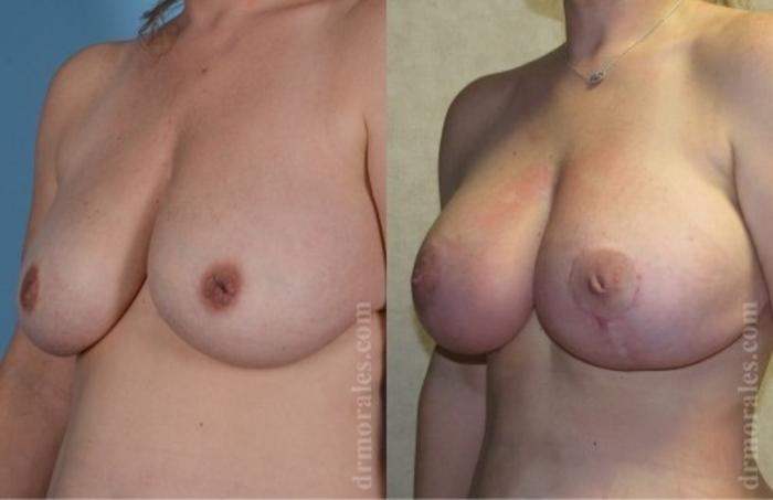 Before & After Breast Augmentation With Lift Case 694 View 1 View in Houston, TX