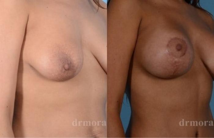 Before & After Breast Augmentation With Lift Case 695 View 1 View in Houston, TX