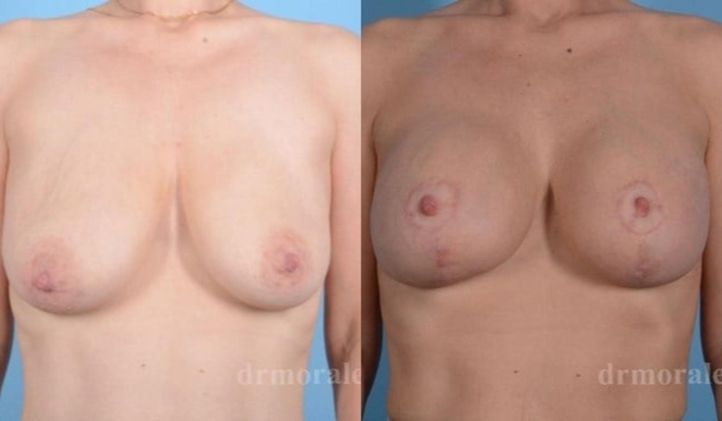 Before & After Breast Augmentation With Lift Case 696 View 1 View in Houston, TX