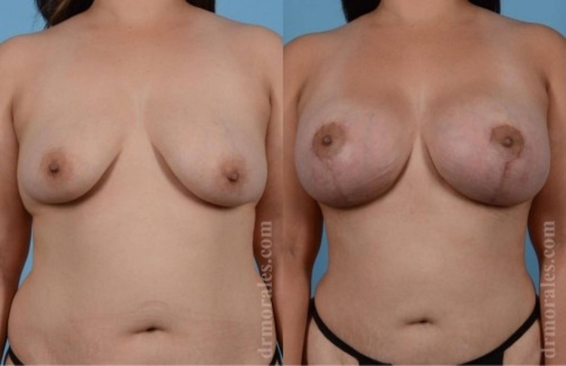 Before & After Breast Augmentation With Lift Case 697 View 1 View in Houston, TX