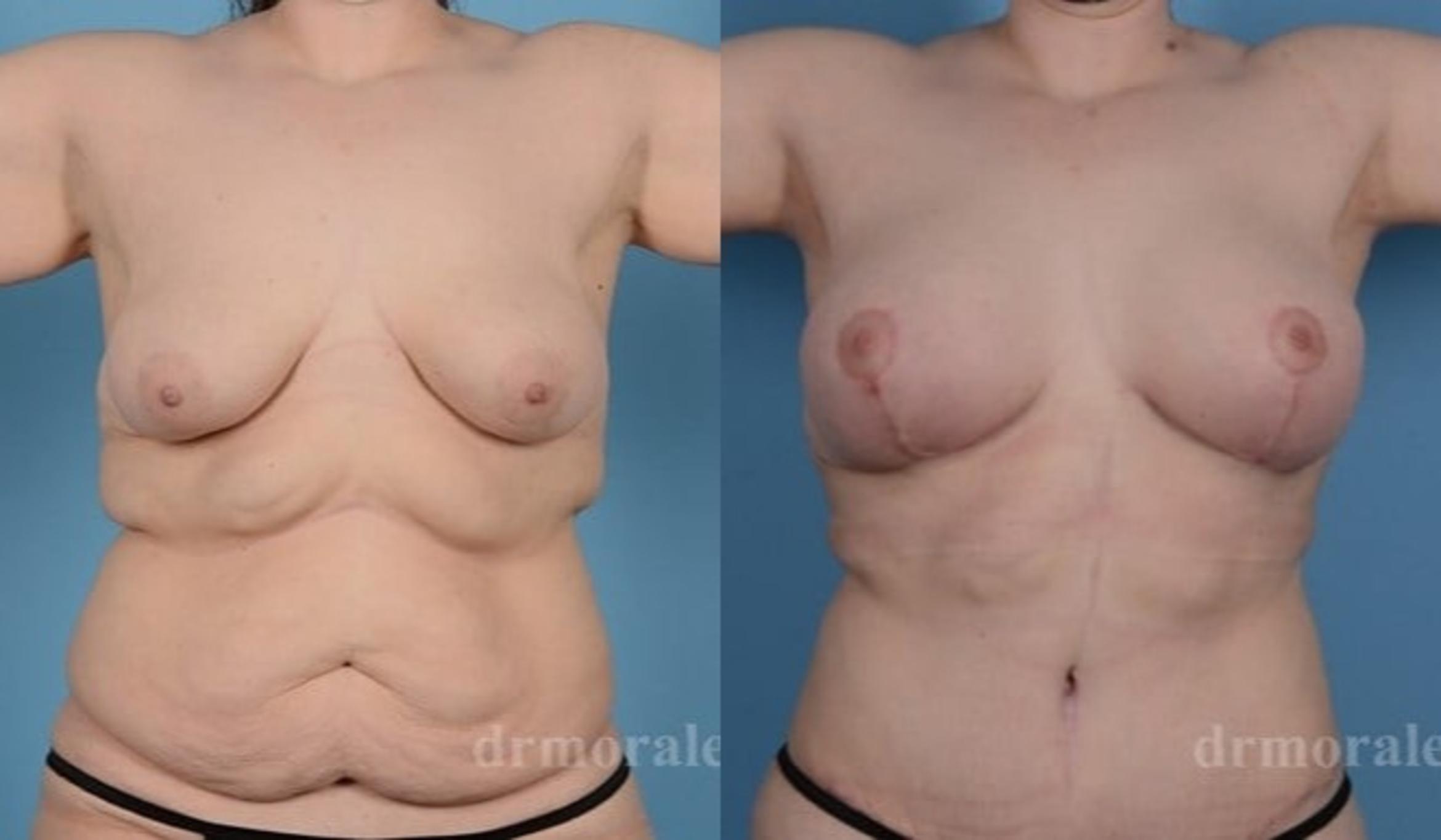 Before & After Breast Augmentation With Lift Case 698 View 1 View in Houston, TX