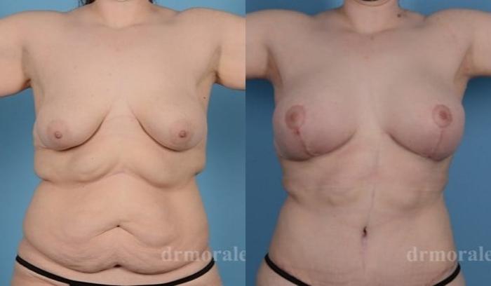 Before & After Breast Augmentation With Lift Case 698 View 1 View in Houston, TX