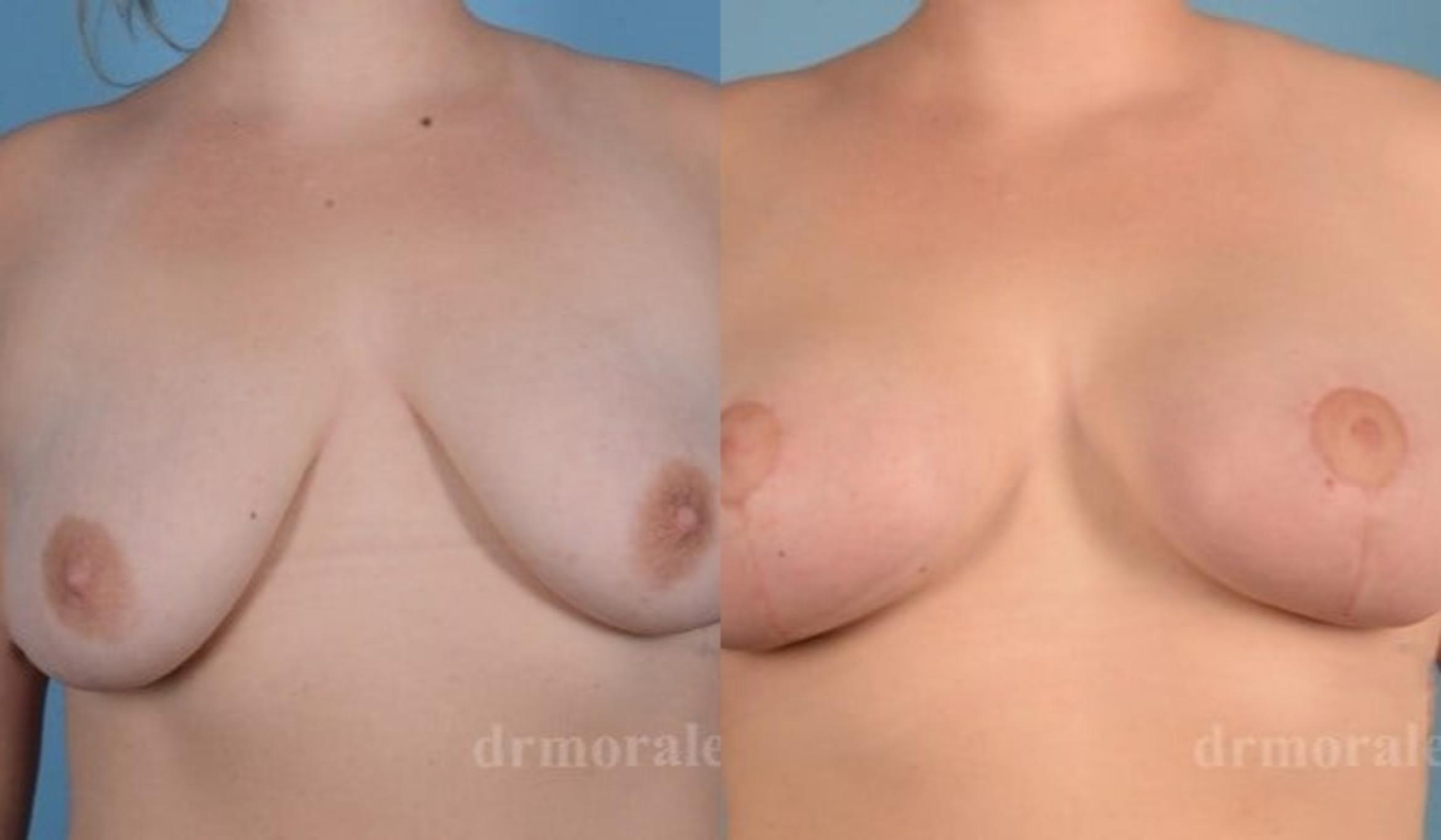Before & After Breast Augmentation With Lift Case 699 View 1 View in Houston, TX