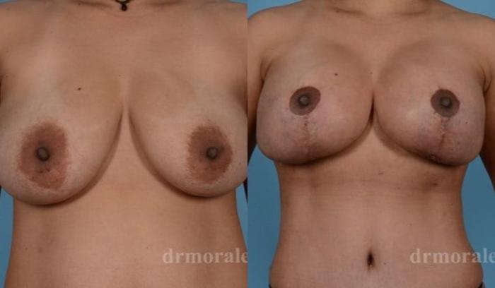 Before & After Breast Augmentation With Lift Case 700 View 1 View in Houston, TX