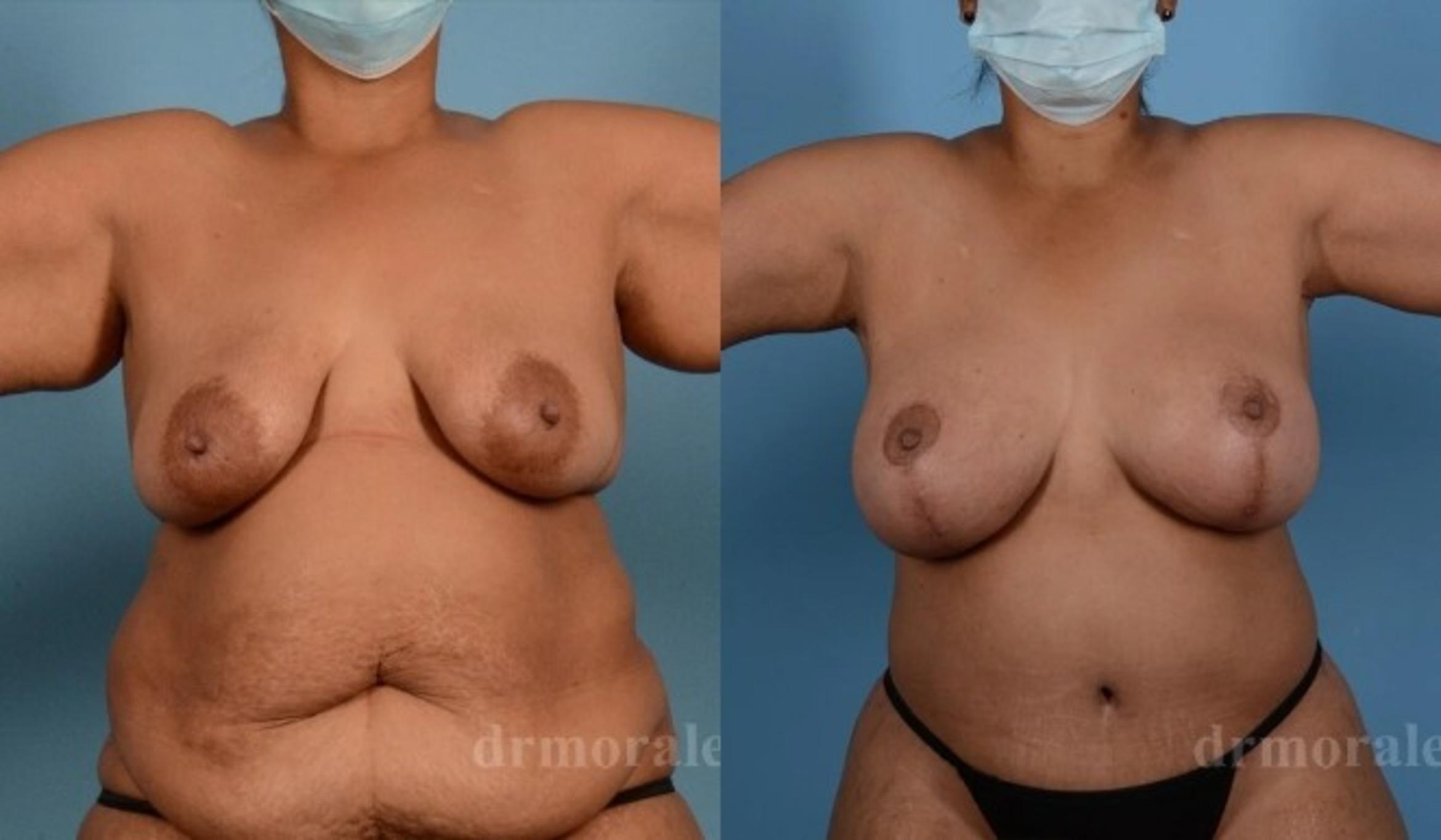 Before & After Breast Augmentation With Lift Case 701 View 1 View in Houston, TX