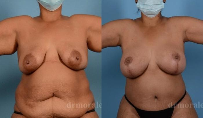 Before & After Breast Augmentation With Lift Case 701 View 1 View in Houston, TX