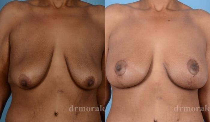 Before & After Breast Augmentation With Lift Case 702 View 1 View in Houston, TX
