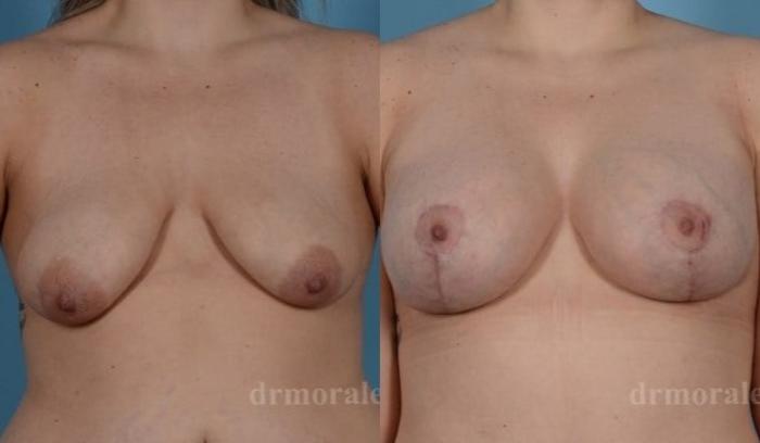 Before & After Breast Augmentation With Lift Case 703 View 1 View in Houston, TX