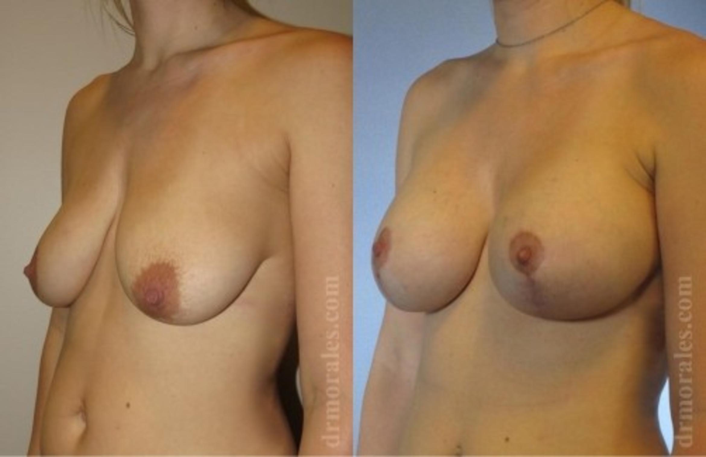 Before & After Breast Augmentation With Lift Case 705 View 1 View in Houston, TX