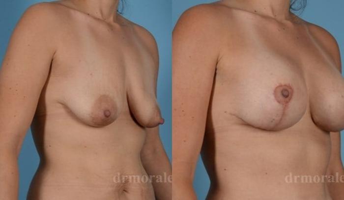 Before & After Breast Augmentation With Lift Case 706 View 1 View in Houston, TX