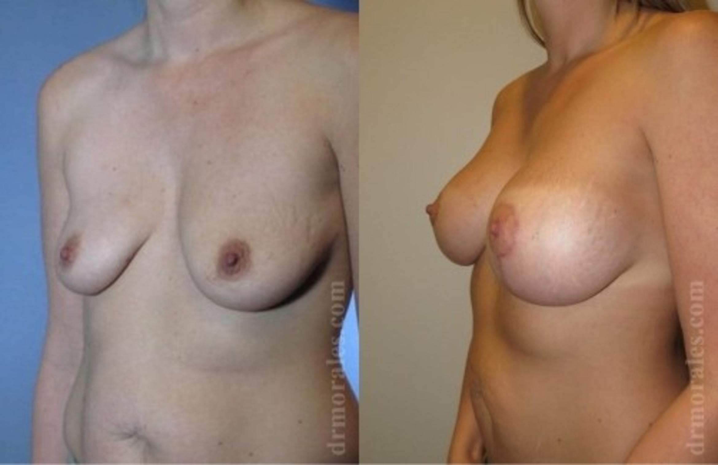 Before & After Breast Augmentation With Lift Case 707 View 1 View in Houston, TX