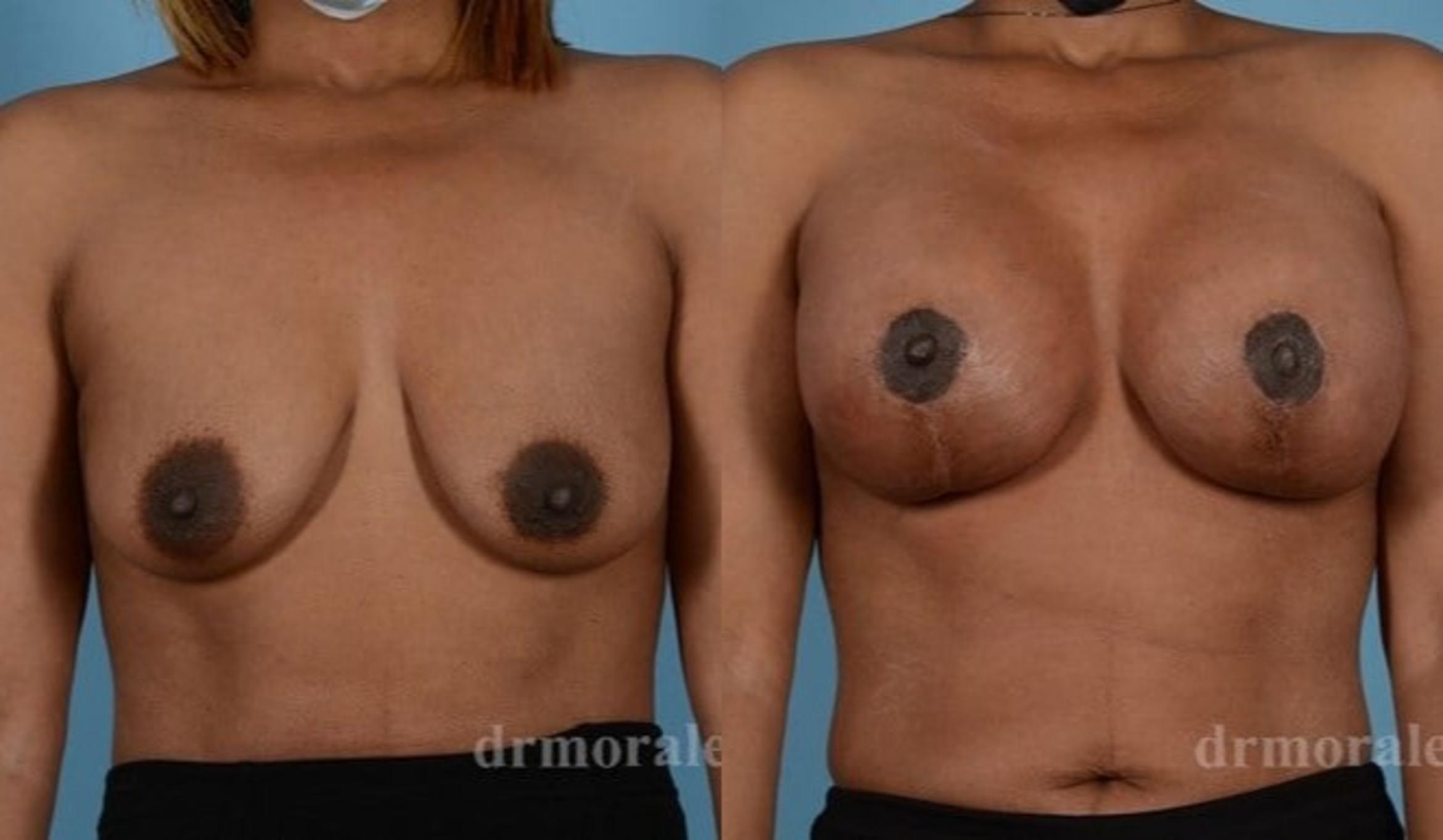 Before & After Breast Augmentation With Lift Case 708 View 1 View in Houston, TX