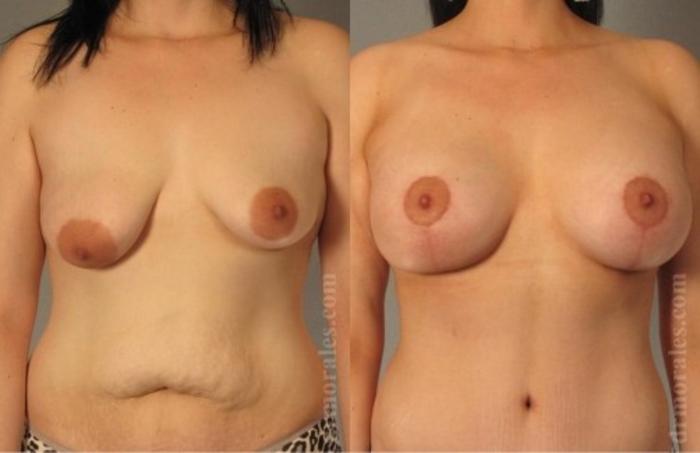 Before & After Breast Augmentation With Lift Case 709 View 1 View in Houston, TX