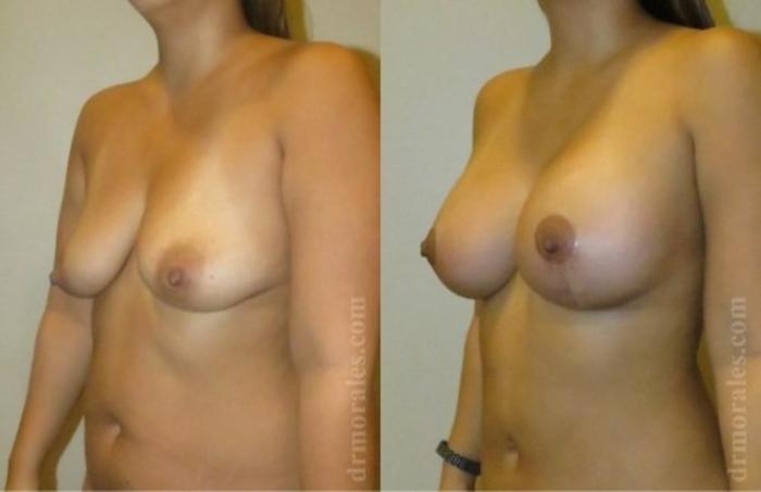 Before & After Breast Augmentation With Lift Case 710 View 1 View in Houston, TX