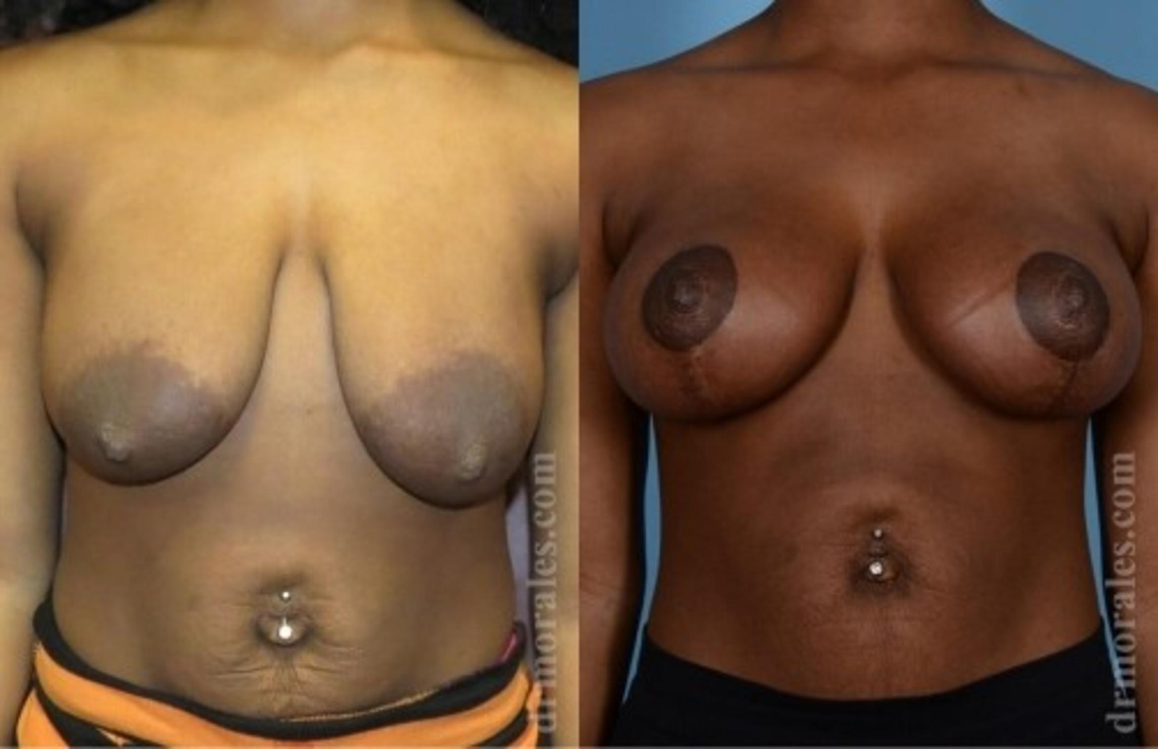 Before & After Breast Augmentation With Lift Case 711 View 1 View in Houston, TX