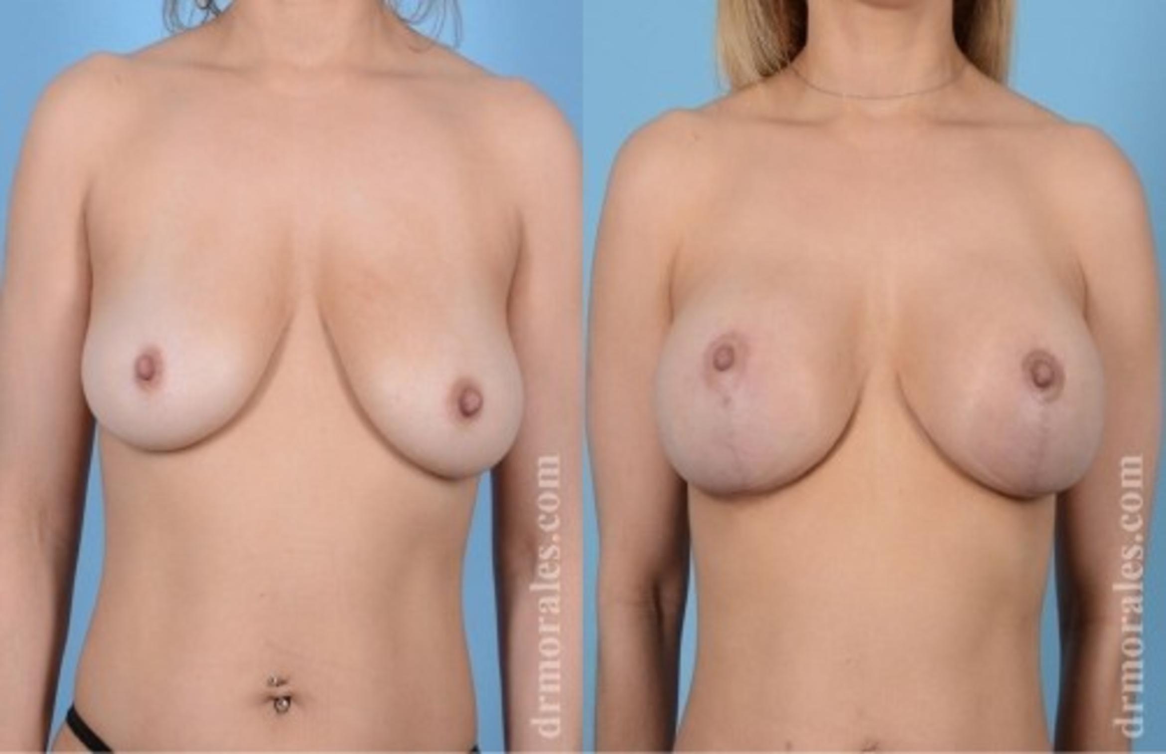 Before & After Breast Augmentation With Lift Case 712 View 1 View in Houston, TX