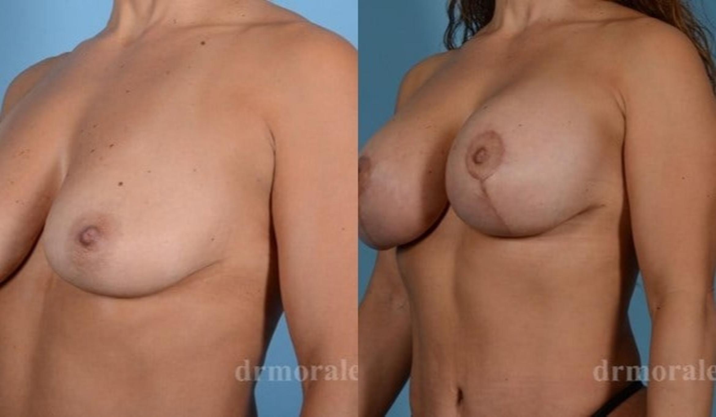Before & After Breast Augmentation With Lift Case 715 View 1 View in Houston, TX