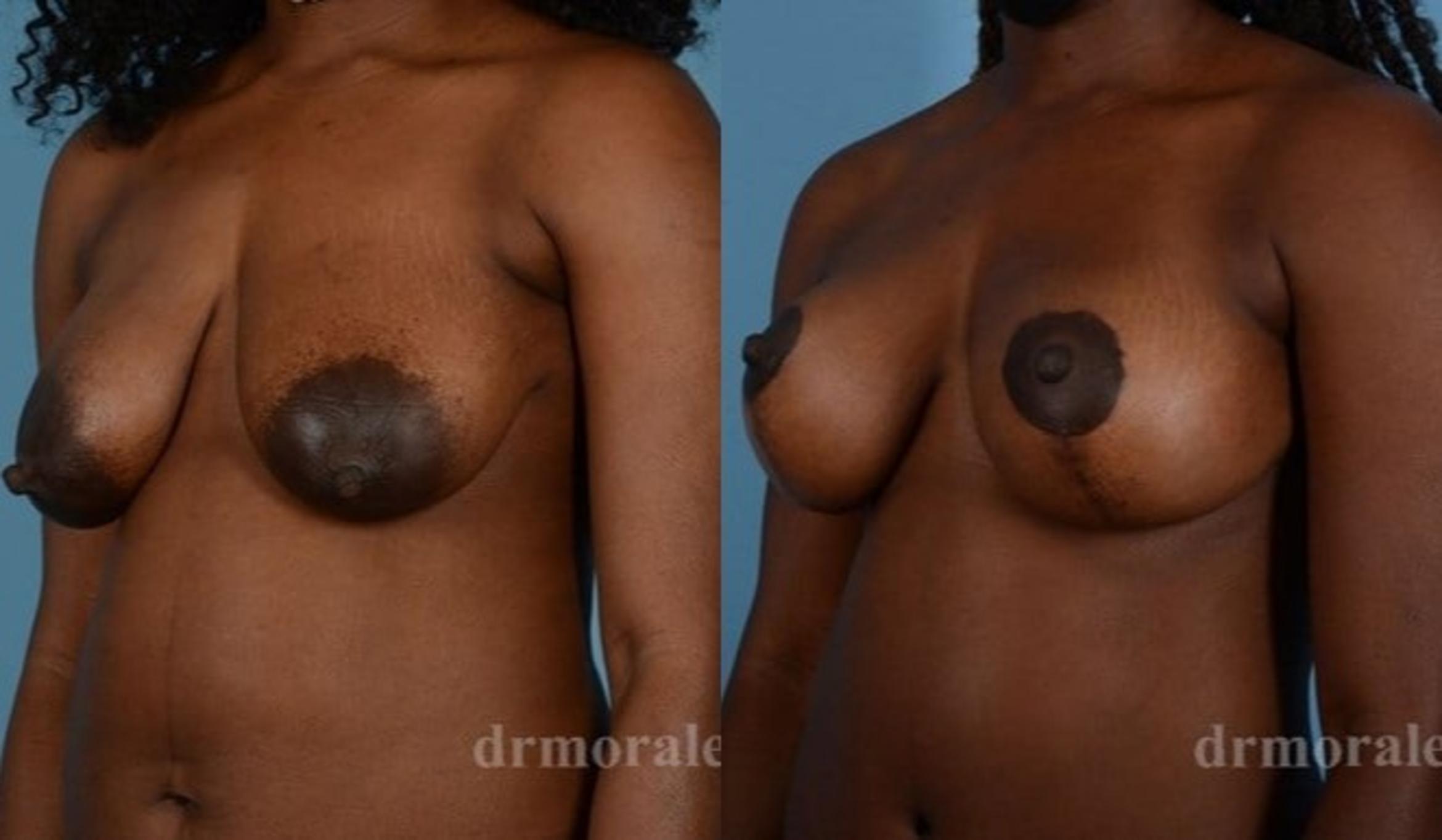 Before & After Breast Augmentation With Lift Case 716 View 1 View in Houston, TX