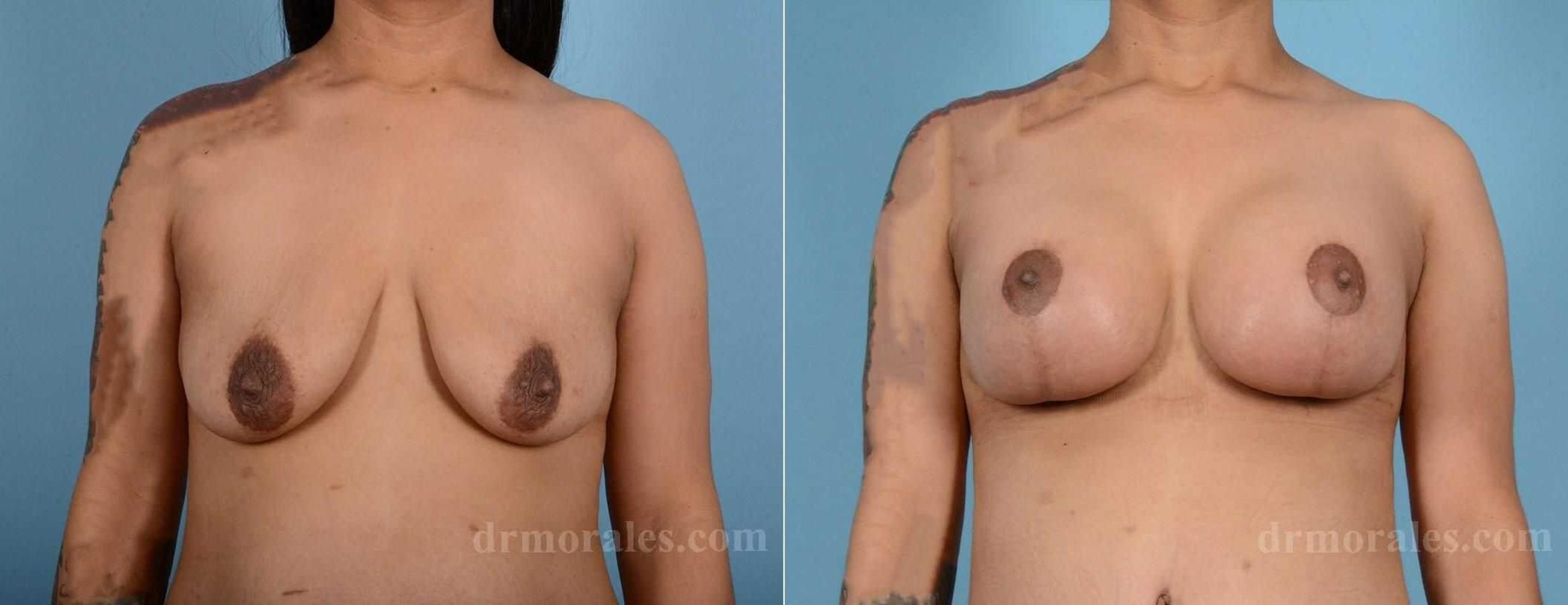 Before & After Breast Augmentation With Lift Case 73 View 1 View in Houston, TX